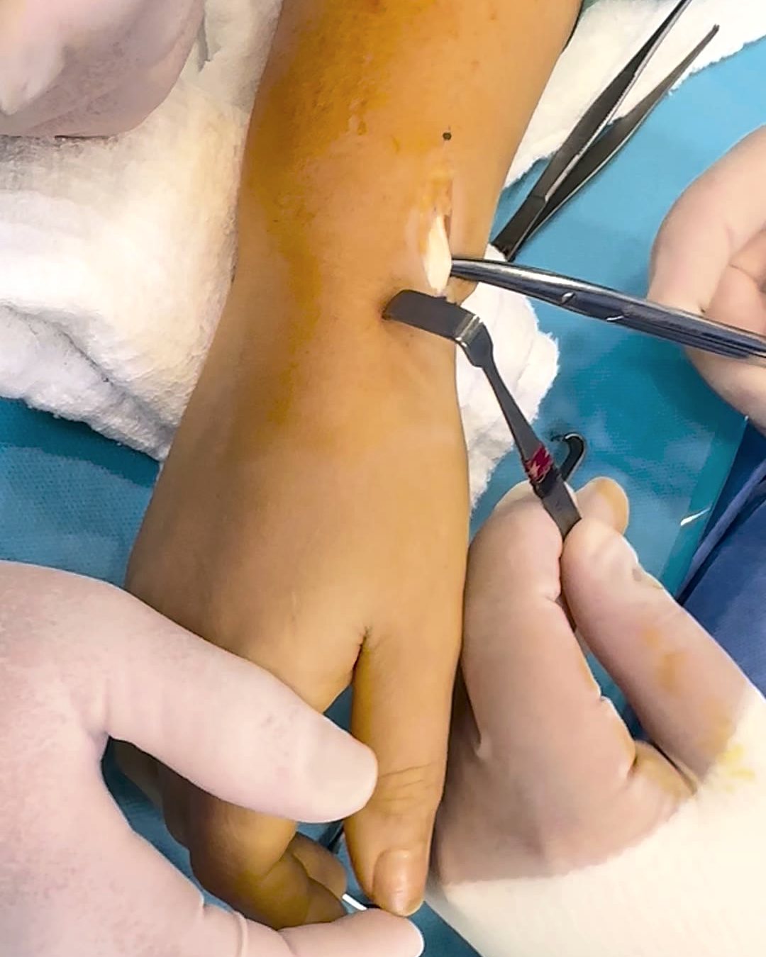 De Quervain ameliyatında bilekte küçük kesiyle tendon kılıfının açılması