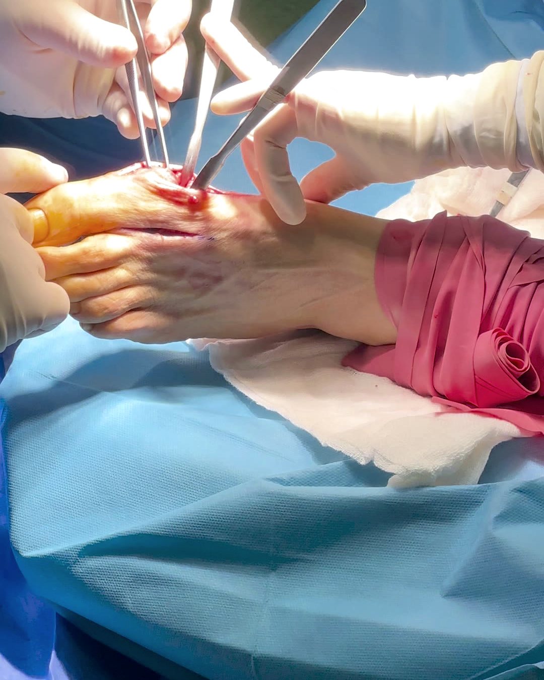 Halluks valgus ameliyatında başparmak eklemine ulaşılması