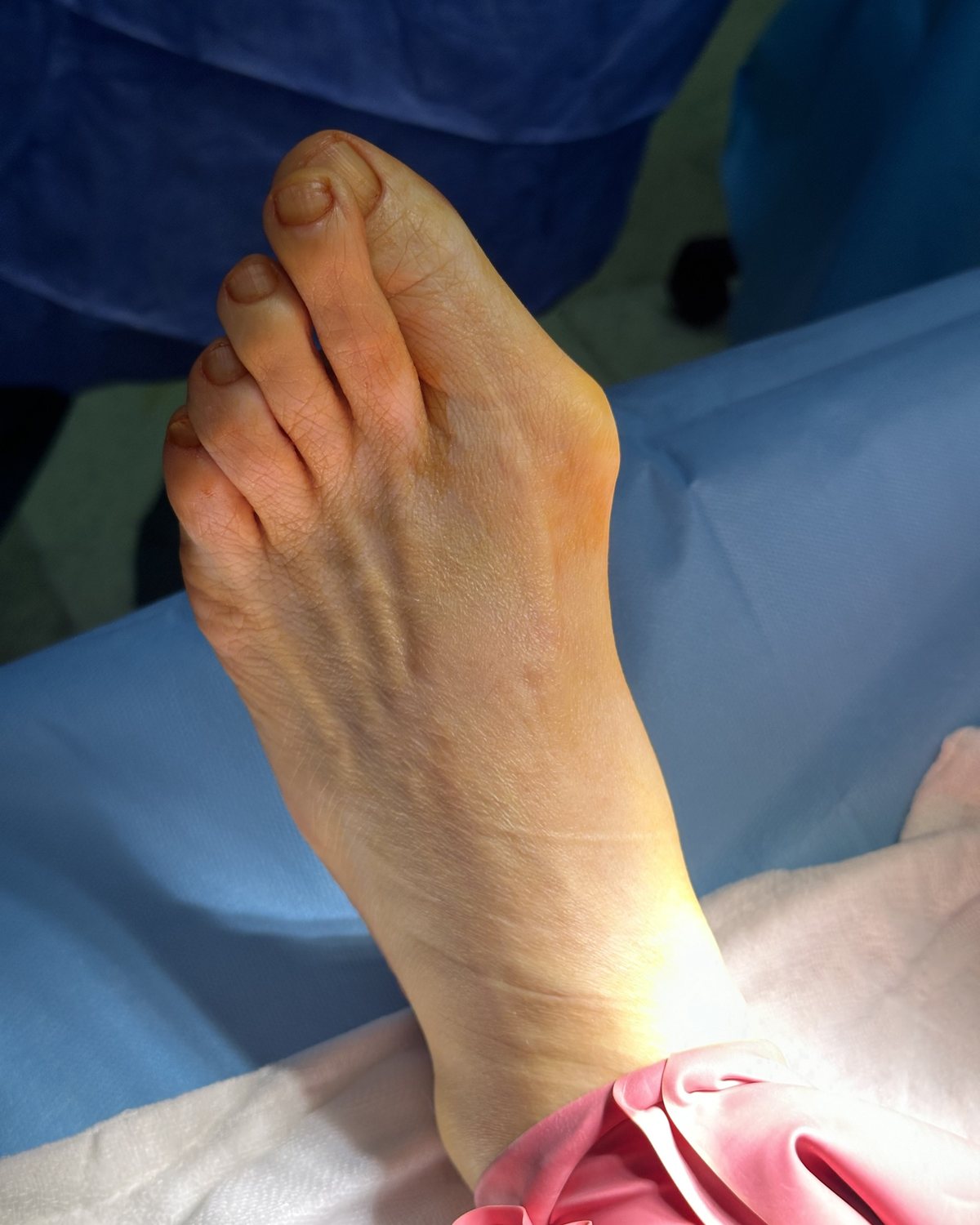 Ayak başparmağı dibinde çıkıntı: halluks valgus