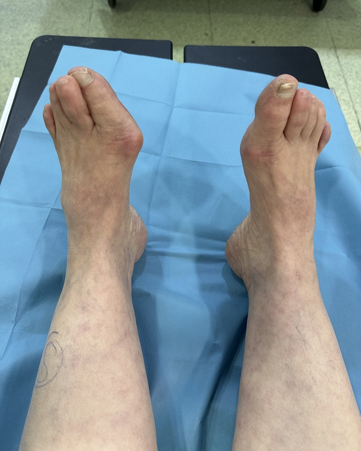 Her iki ayakta başparmak çıkıntısı (halluks valgus), ameliyat öncesi