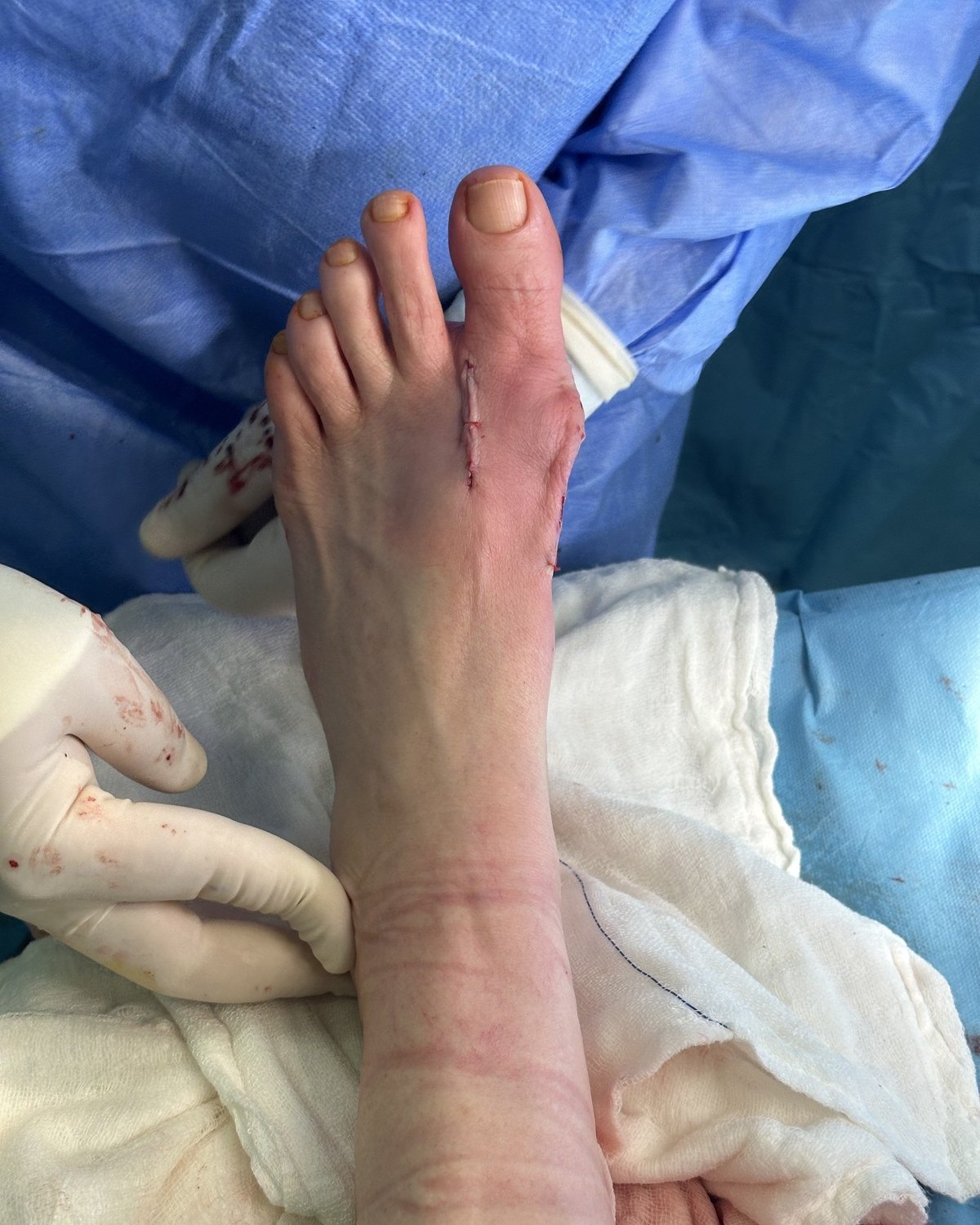 Halluks valgus ameliyatından hemen sonra düzelmiş başparmak